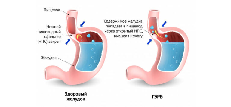 Оптимальной схемой лечения гэрб с внепищеводными проявлениями является